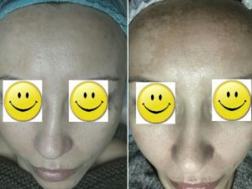 Как избежать пигментации после прыщей. Почему чистку лица приходится делать постоянно, как решить проблемы с лицом раз и навсегда