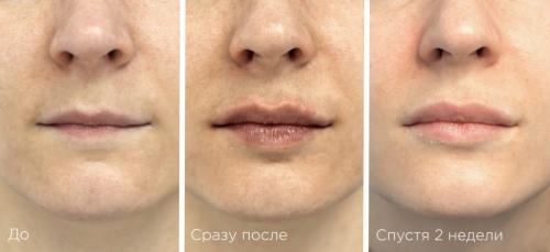 Как долго после филлеров нужно проходить реабилитацию. Реабилитация после увеличения губ: что можно и что нельзя