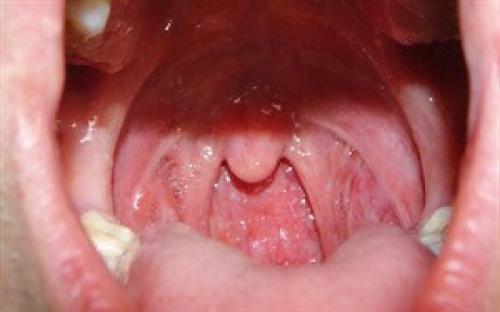Болит горло, больно глотать температуры нет. Как вылечить сильную боль в горле при глотании и в чем причины ее возникновения