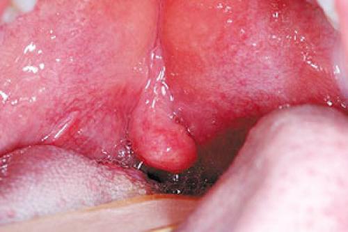 Болит горло, больно глотать температуры нет. Как вылечить сильную боль в горле при глотании и в чем причины ее возникновения