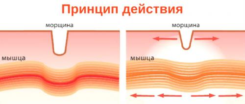 Ботулотоксин в косметологии противопоказания. Ботокс - что это такое и на что способен препарат? 03 Ботулотоксин в косметологии противопоказания. Ботокс - что это такое и на что способен препарат? 03