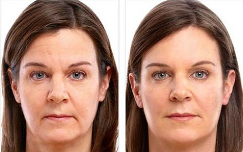 Безопасность косметологических процедур после инъекций ботокса: что нужно знать 15