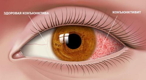 Как вылечить хронический конъюнктивит? Конъюнктивит —, какой он и чем опасен? 02 Как вылечить хронический конъюнктивит? Конъюнктивит —, какой он и чем опасен? 02