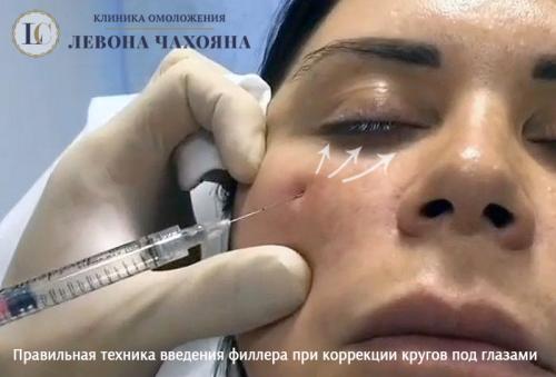 Как убрать морщины под глазами инъекциями. Какие препараты от кругов (синяков) под глазами можно использовать?