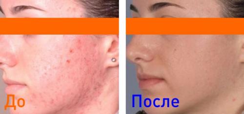 Плазмолифтинг вокруг глаз. Плазмотерапия