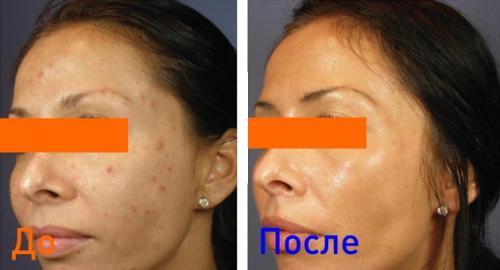 Плазмолифтинг вокруг глаз. Плазмотерапия