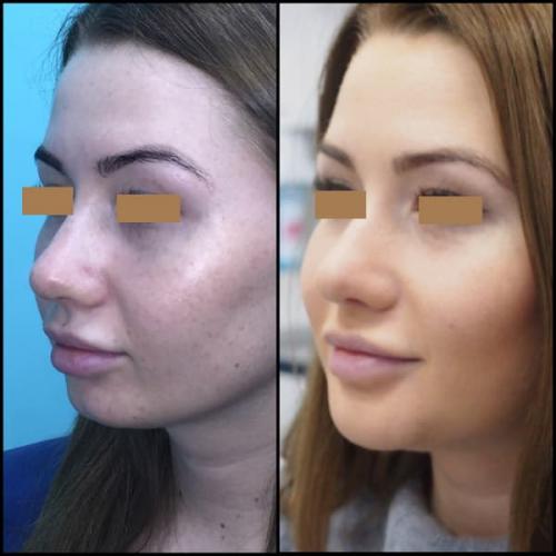 Удаление комочков Биша без операции. Комки Биша — удалять или не удалять? 08 Удаление комочков Биша без операции. Комки Биша — удалять или не удалять? 08