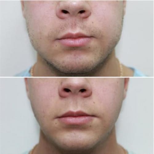 Удаление комочков Биша без операции. Комки Биша — удалять или не удалять? 04 Удаление комочков Биша без операции. Комки Биша — удалять или не удалять? 04