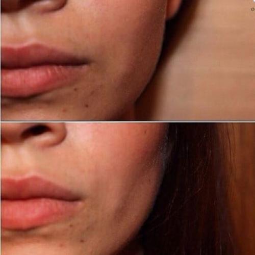 Удаление комочков Биша без операции. Комки Биша — удалять или не удалять? 02 Удаление комочков Биша без операции. Комки Биша — удалять или не удалять? 02