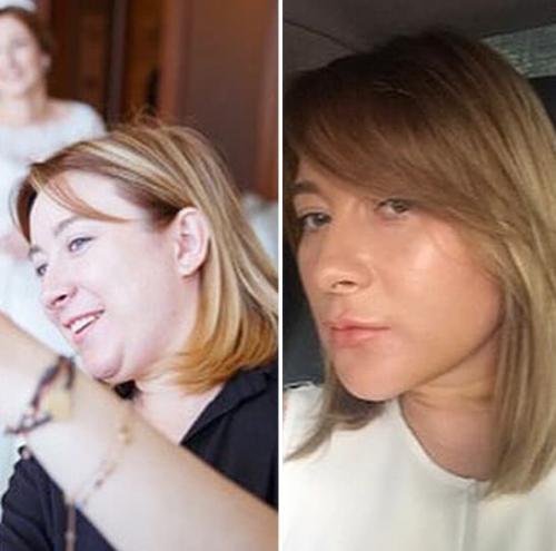 Удаление комочков Биша без операции. Комки Биша — удалять или не удалять? 11 Удаление комочков Биша без операции. Комки Биша — удалять или не удалять? 11