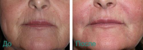 Как убрать носогубные складки в 60 лет. Удаление носогубных складок на лице