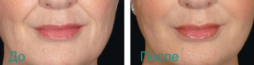 Как убрать носогубные складки в 60 лет. Удаление носогубных складок на лице