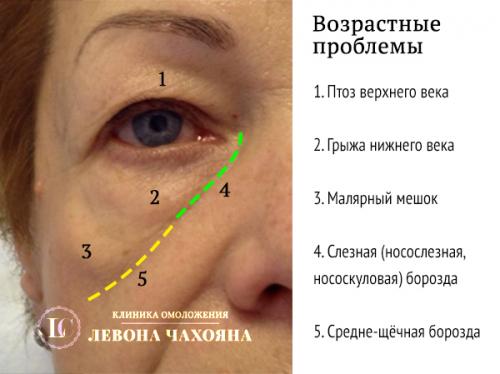 Что лучше колоть под глаза от морщин. Самое главное, понять, что же это такое - мешки под глазами.