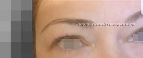 Коррекция после процедуры ботокса. Ботокс: что нельзя делать после процедуры 06 Коррекция после процедуры ботокса. Ботокс: что нельзя делать после процедуры 06