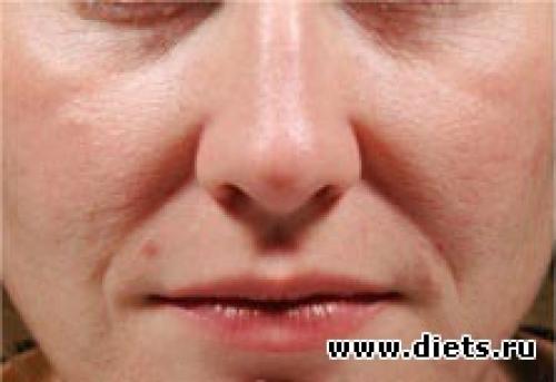 Как избавиться от носогубных складок. Как убрать носогубные складки? 05