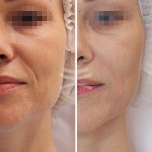 Что лучше Ботокс или биоревитализация. Инъекционные техники