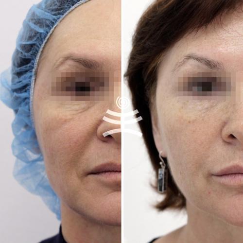 Что лучше Ботокс или биоревитализация. Инъекционные техники