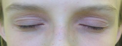 Почему чешется веко глаза. Причины блефарита 06 Почему чешется веко глаза. Причины блефарита 06