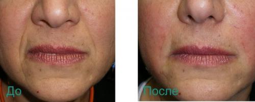 Носогубные складки коррекция. Удаление носогубных складок на лице
