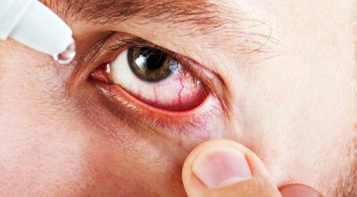 Конъюнктивит у детей и взрослых. 02 Конъюнктивит у детей и взрослых. 02