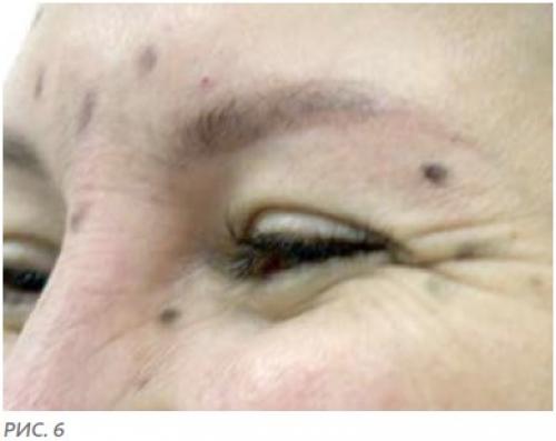 Уколы от морщин вокруг глаз. Этапы проведения инъекций ботокса 05