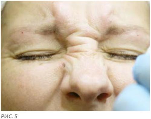 Уколы от морщин вокруг глаз. Этапы проведения инъекций ботокса 04