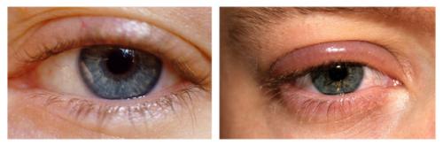 Отек над глазом под бровью. Симптомы блефарита