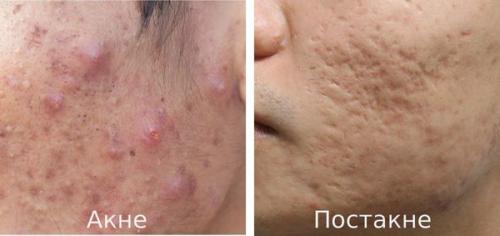 Чем можно убрать следы от прыщей. Как убрать следы от прыщей на лице 01 Чем можно убрать следы от прыщей. Как убрать следы от прыщей на лице 01