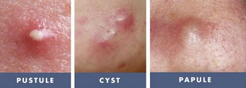 Чем можно убрать следы от прыщей. Как убрать следы от прыщей на лице 02 Чем можно убрать следы от прыщей. Как убрать следы от прыщей на лице 02