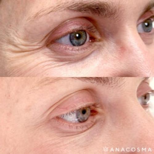 Как убрать гусиные лапки под глазами. Как убрать гусиные лапки?