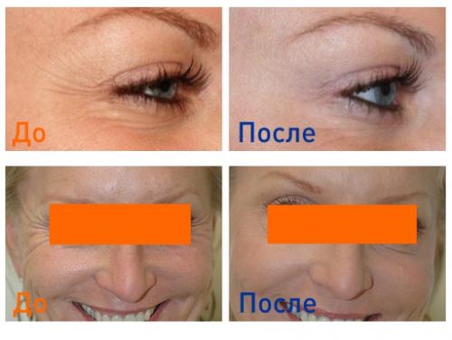 Инъекции Диспорта вокруг глаз. Уколы и инъекции Диспорта