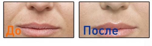 Уколы красоты названия препаратов. Сравнительный анализ методов и иъекций