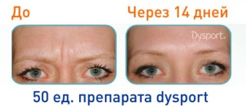 Уколы красоты названия препаратов. Сравнительный анализ методов и иъекций