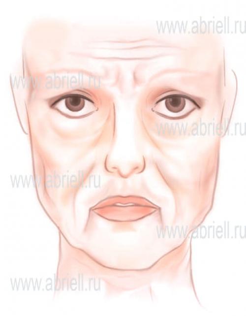 Как убрать морщины у глаз. Как убрать морщины вокруг глаз 02 Как убрать морщины у глаз. Как убрать морщины вокруг глаз 02